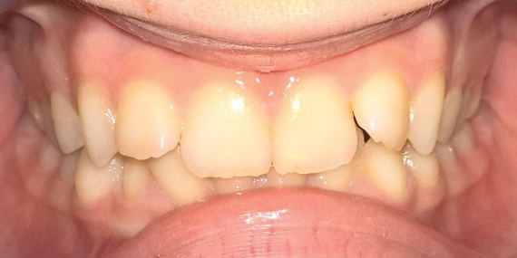 before